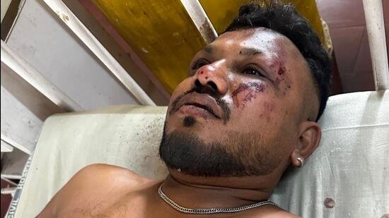 Vishwash Kumar Ramesh, survivant du Air India crash Ahmedabad,prenant des soins apres le Air India crash Ahmedabad.